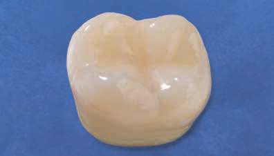 Ecusphere Shape A3.5 - после реставрации